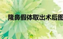 隆鼻假体取出术后图（隆鼻假体取出术）