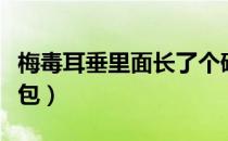 梅毒耳垂里面长了个硬包（耳垂里面长了个硬包）