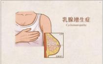 常生闷气的女性更容易乳腺增生